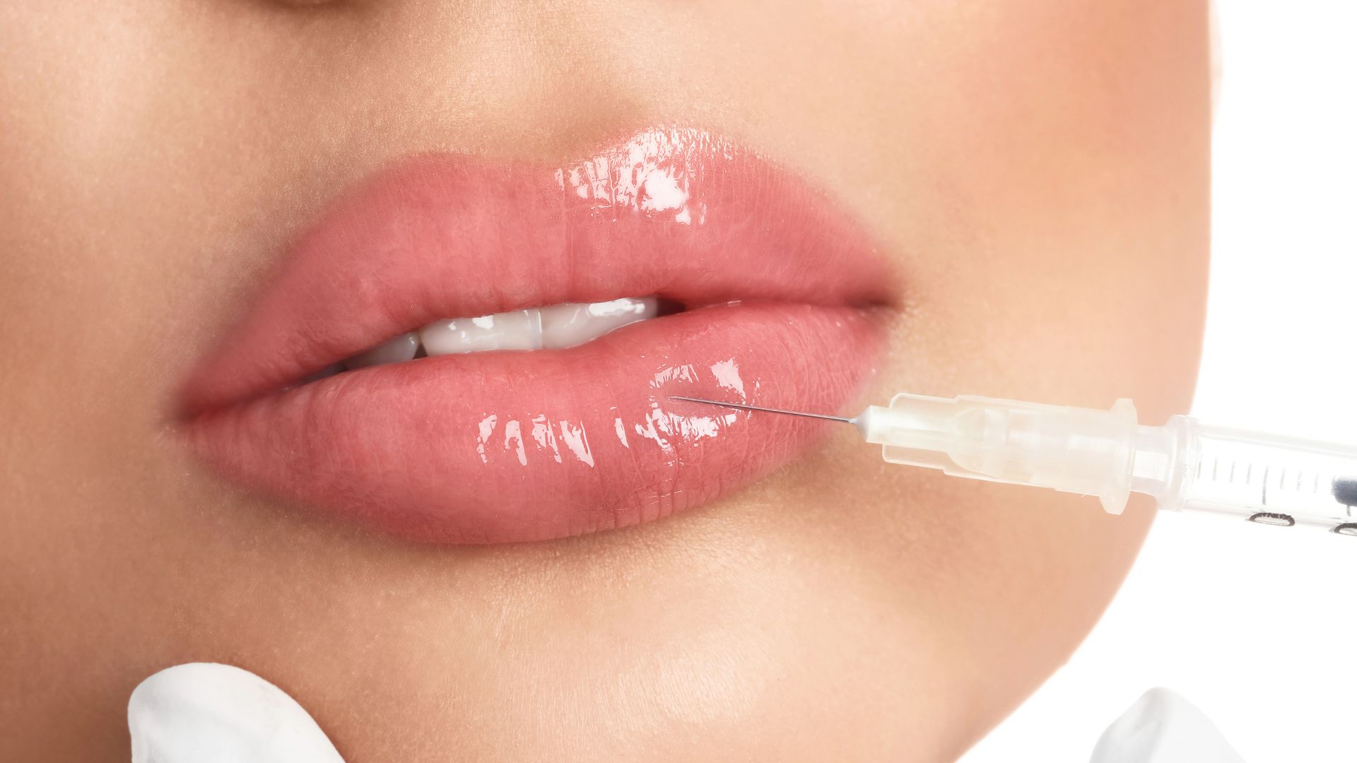Lip injection procedure with syringe injecting filler into glossy lips